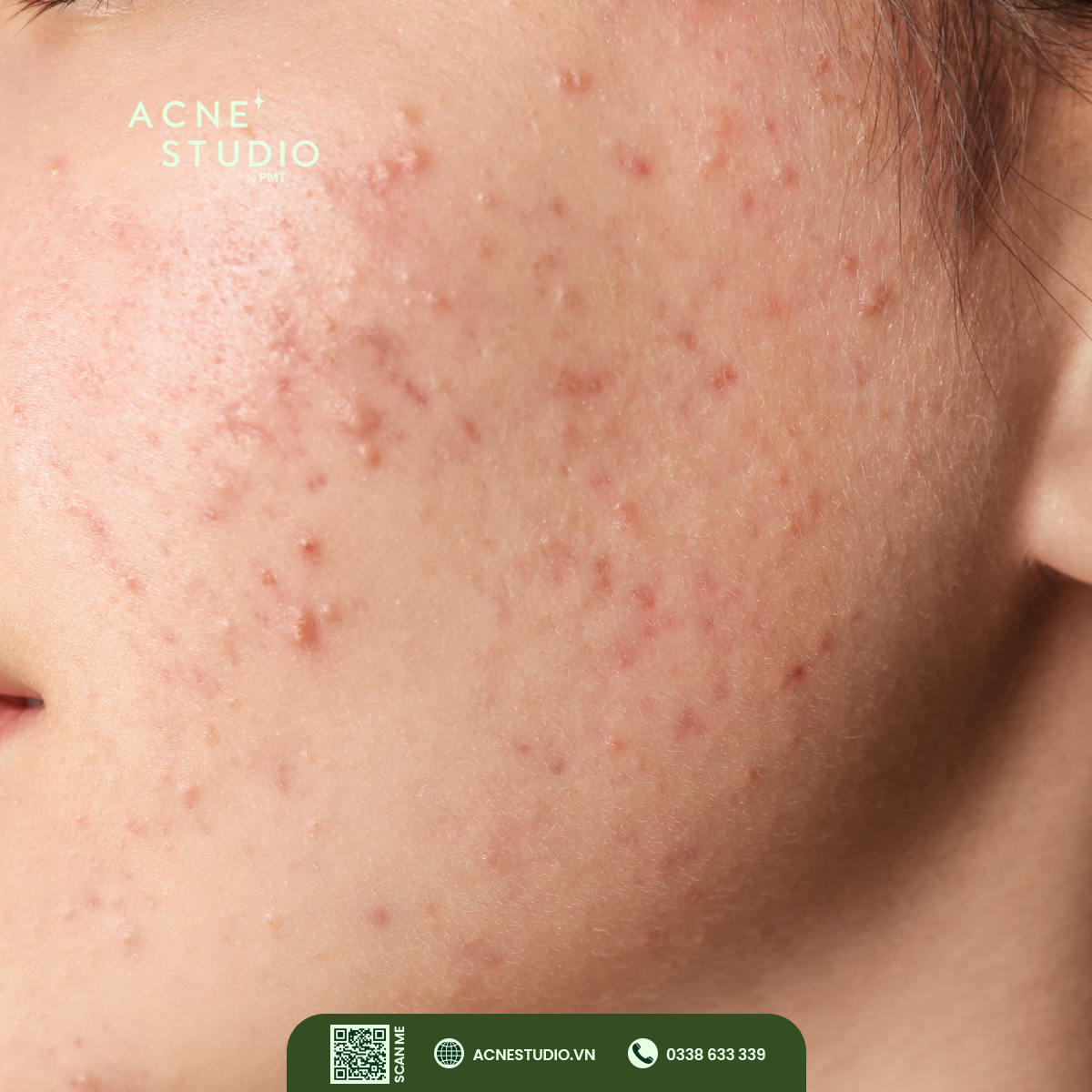 Các loại mụn thường gặp