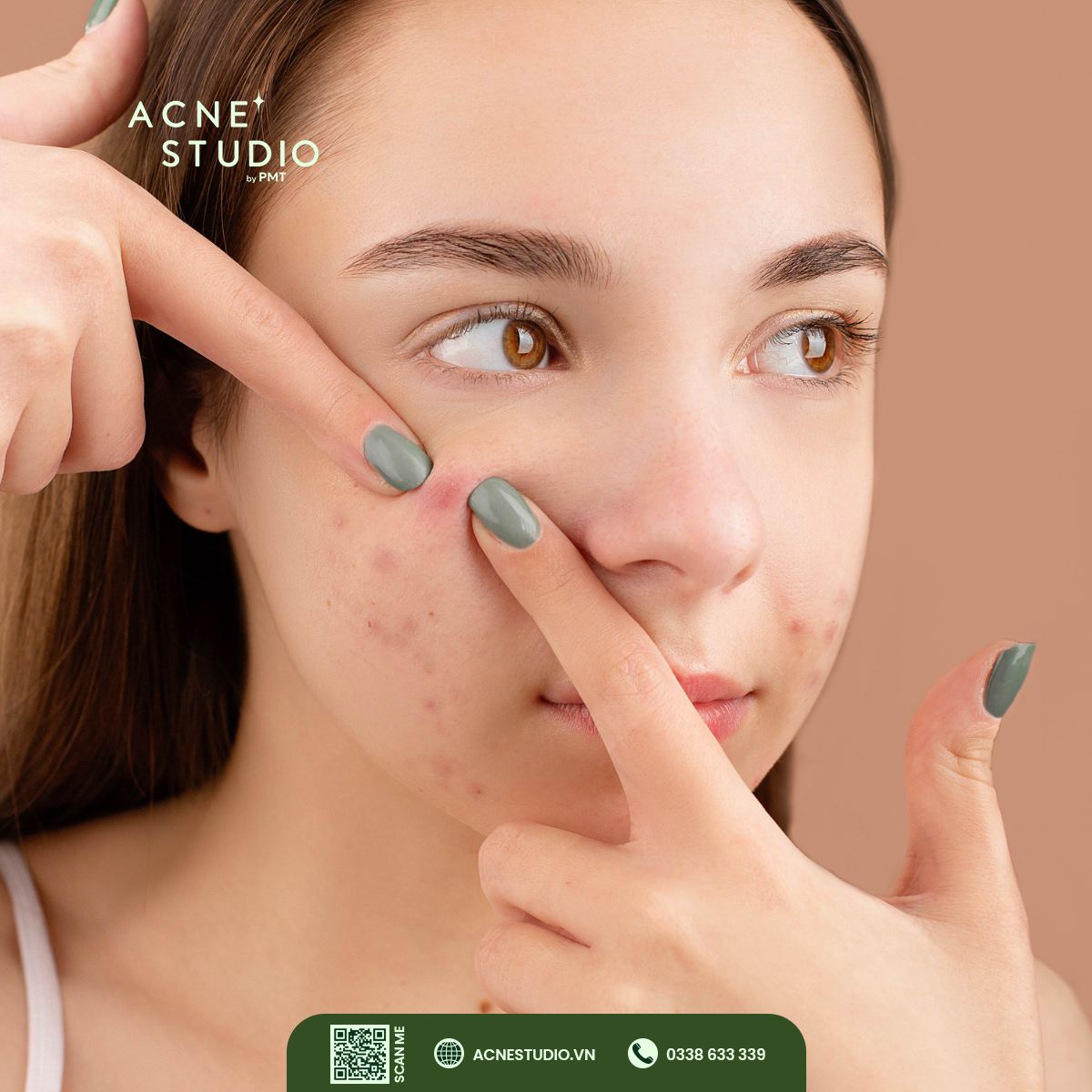 Sai lầm thường gặp dẫn đến không hết mụn