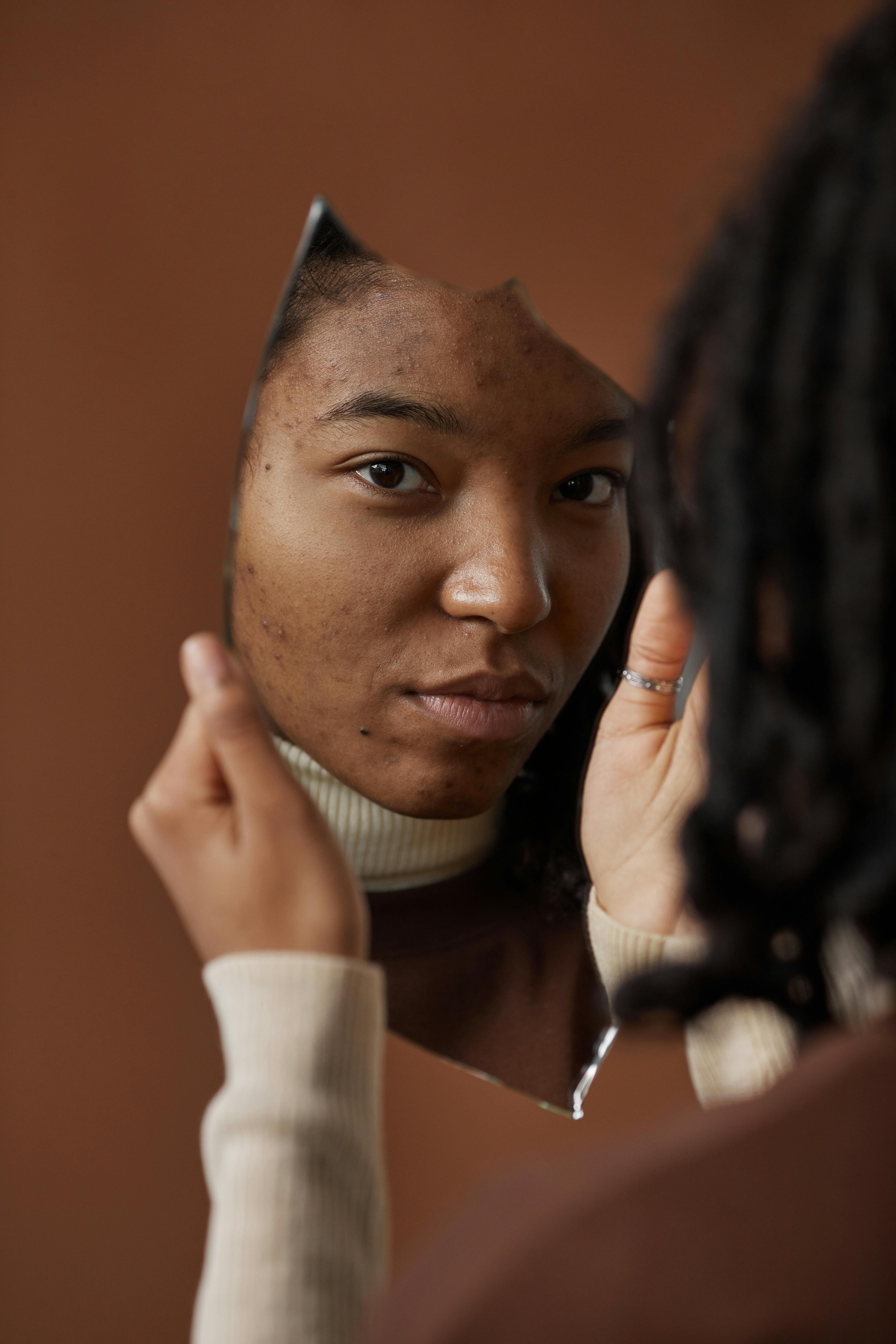 Trị Mụn Không Thuốc Tại Acne Studio - Công Nghệ An Toàn Hiệu Quả