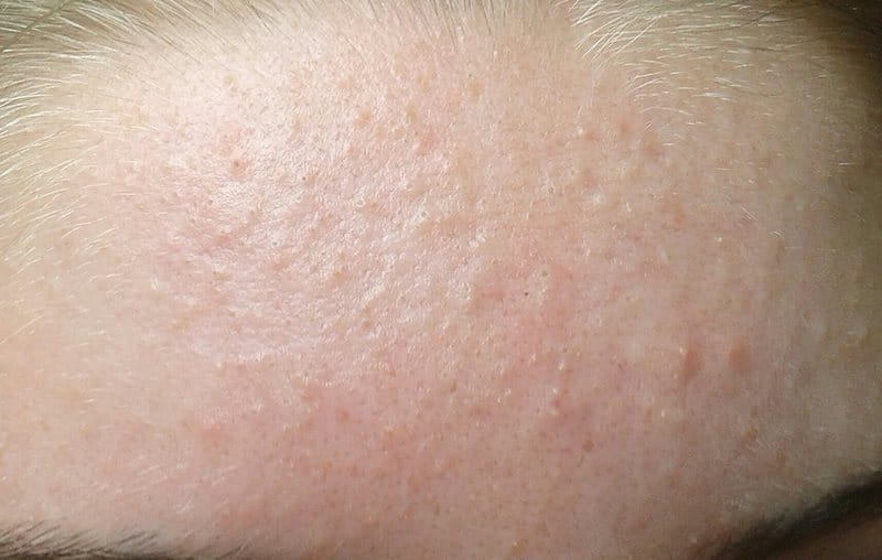 Trị mụn cho da yếu không cần thuốc tại ACNE STUDIO