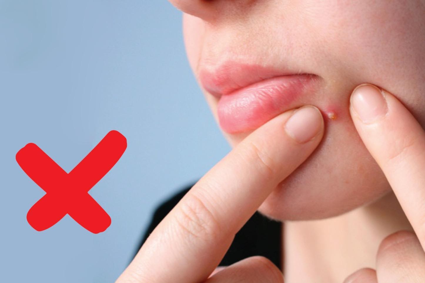 Kiểm soát mụn bằng khoa học tại ACNE STUDIO – Không dùng kháng sinh