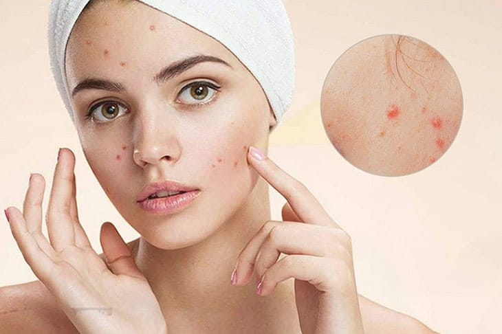 Kiểm soát mụn bằng khoa học tại ACNE STUDIO – Không dùng kháng sinh