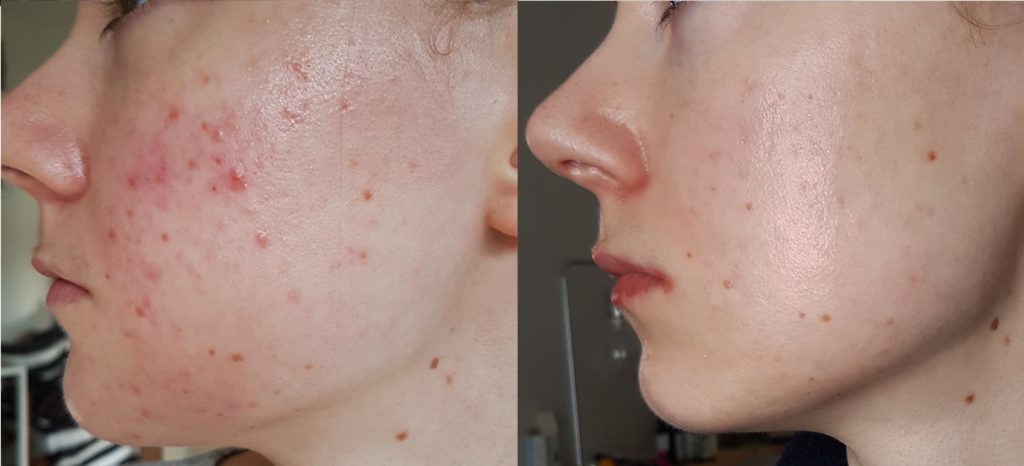 Chấm Dứt Thuốc Trị Mụn: Giải Pháp An Toàn Từ ACNE STUDIO