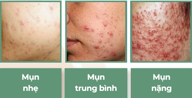 Chấm Dứt Thuốc Trị Mụn: Giải Pháp An Toàn Từ ACNE STUDIO