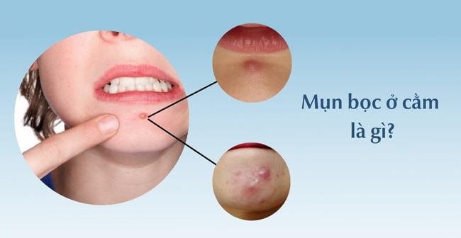 Chấm Dứt Thuốc Trị Mụn: Giải Pháp An Toàn Từ ACNE STUDIO