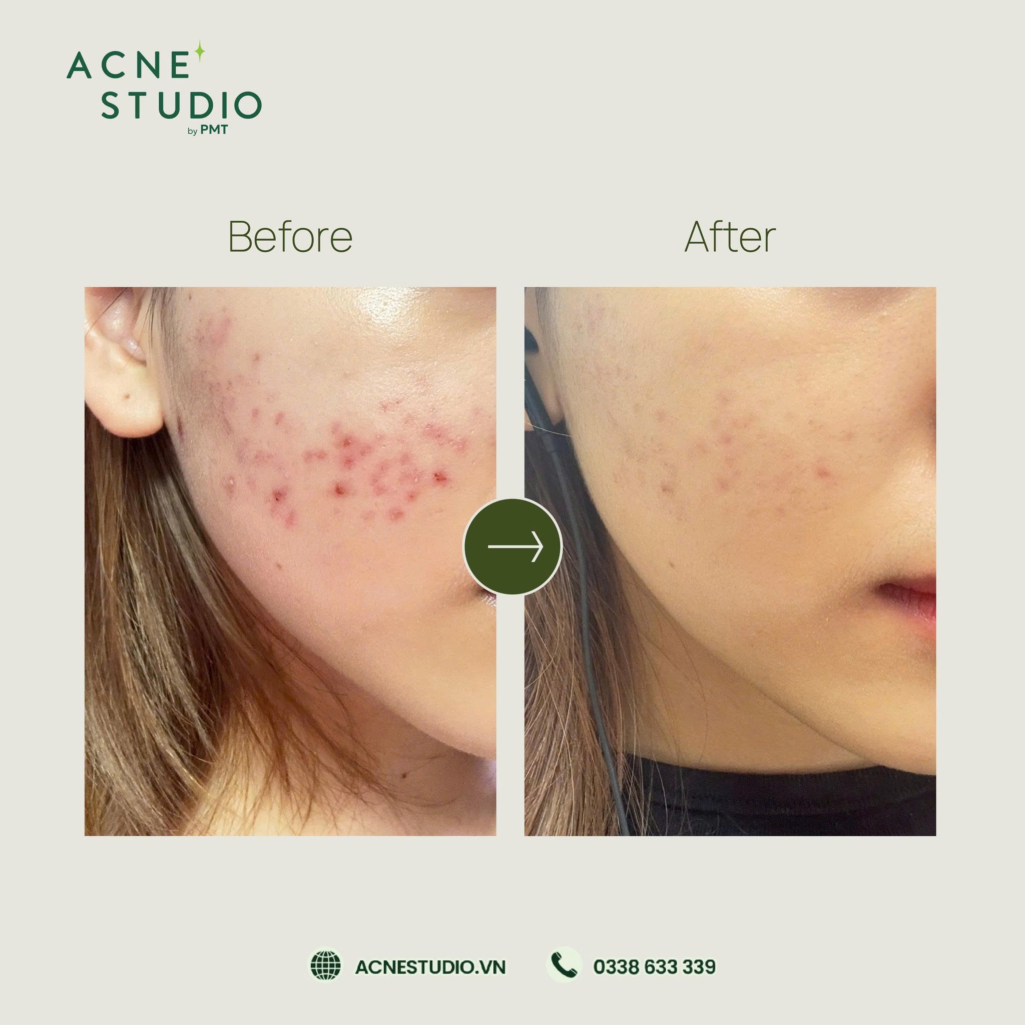 Hiệu quả kiểm soát mụn sau 3 buổi Acne Pro