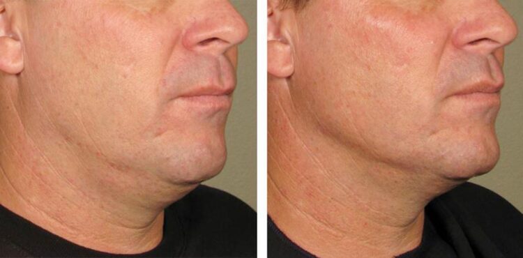 Khám Phá Hiệu Quả Nâng Cơ Vùng Mặt, Cổ với Ultherapy Prime