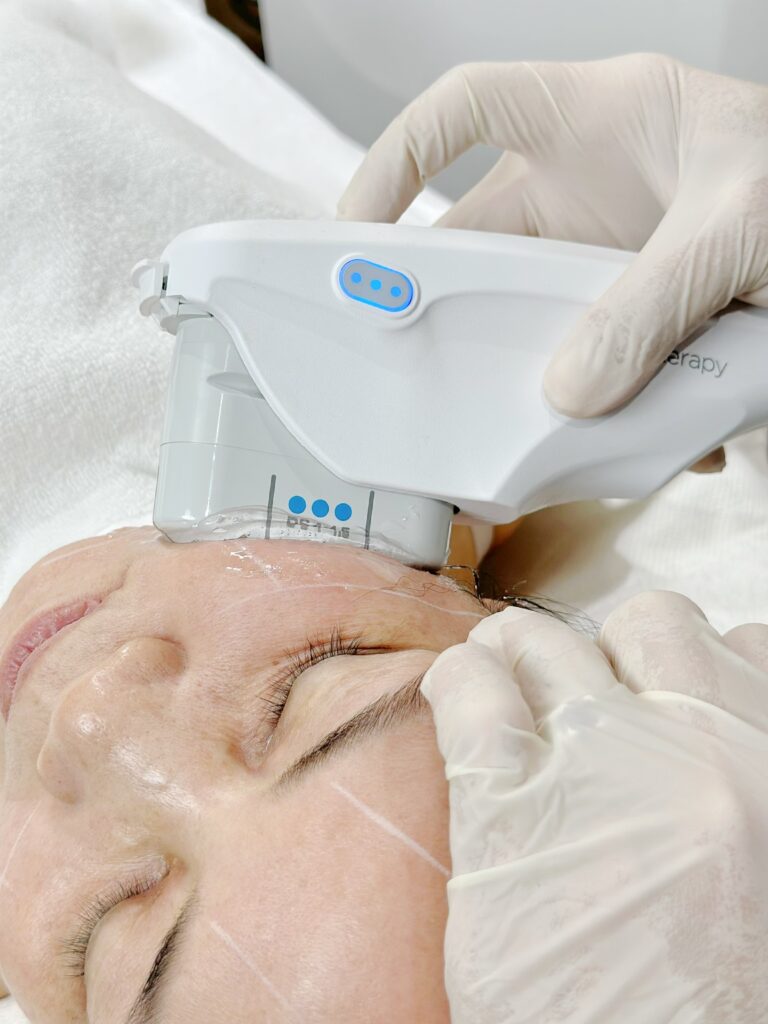 Ultherapy Prime 2026: Đánh Giá Hiệu Quả Nâng Cơ Không Phẫu Thuật