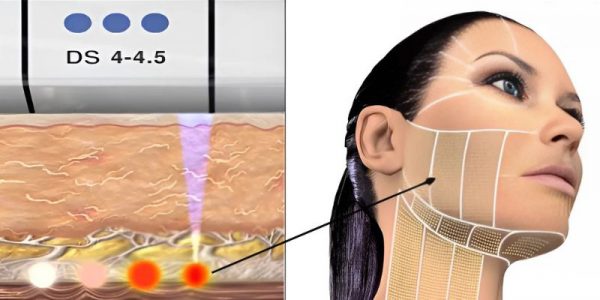 Ultherapy Prime 2026: Đánh Giá Hiệu Quả Nâng Cơ Không Phẫu Thuật