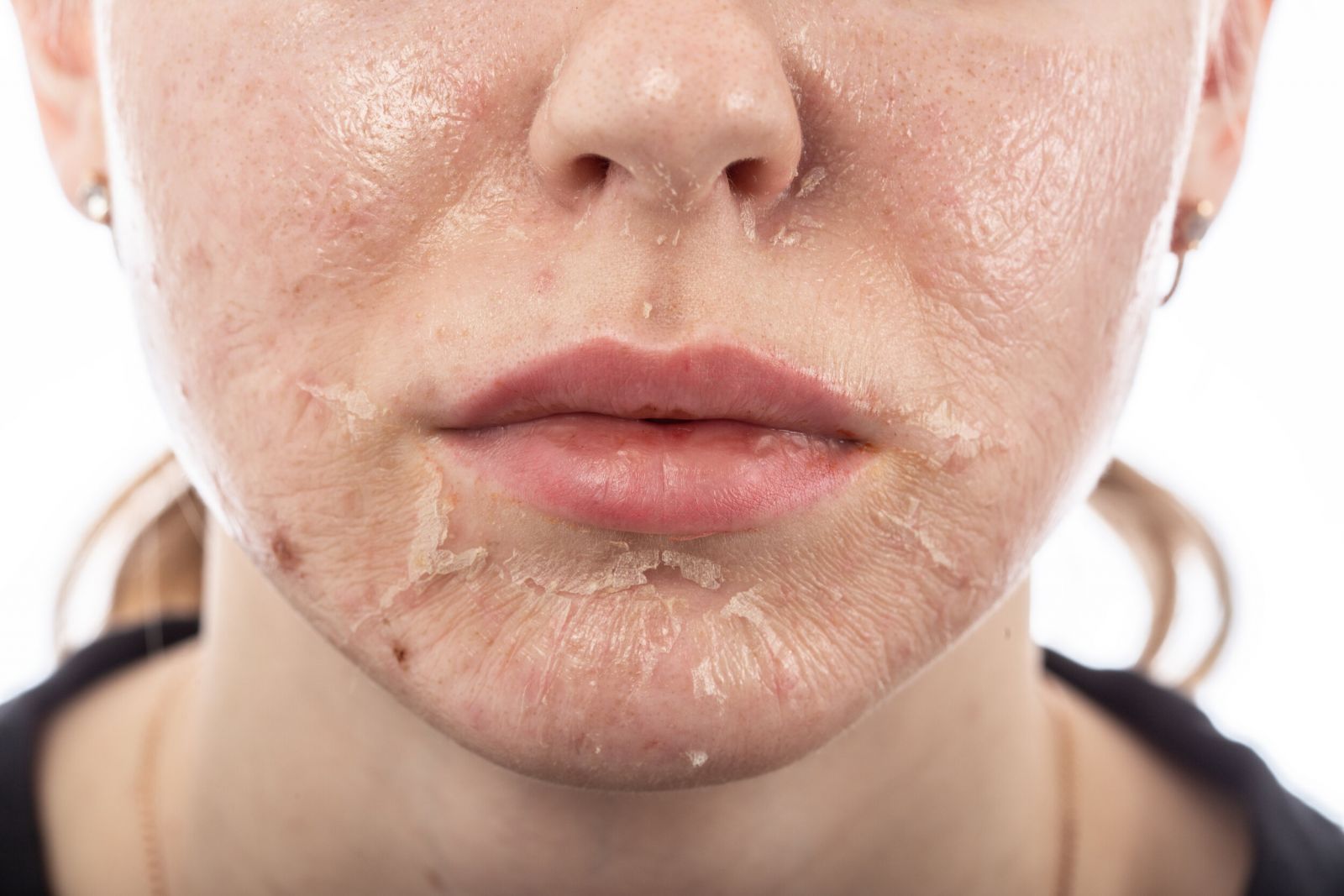 Workshop Phục Hồi Da Hư Tổn của ACNE STUDIO tại Rạch Giá