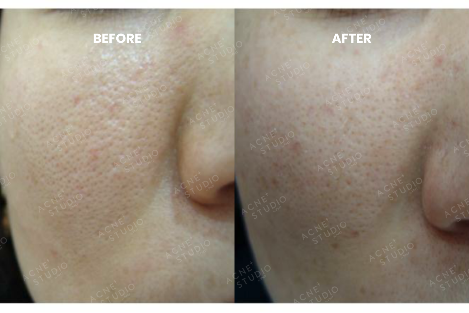 Hiệu quả sau khi thực hiện RENEW SKIN