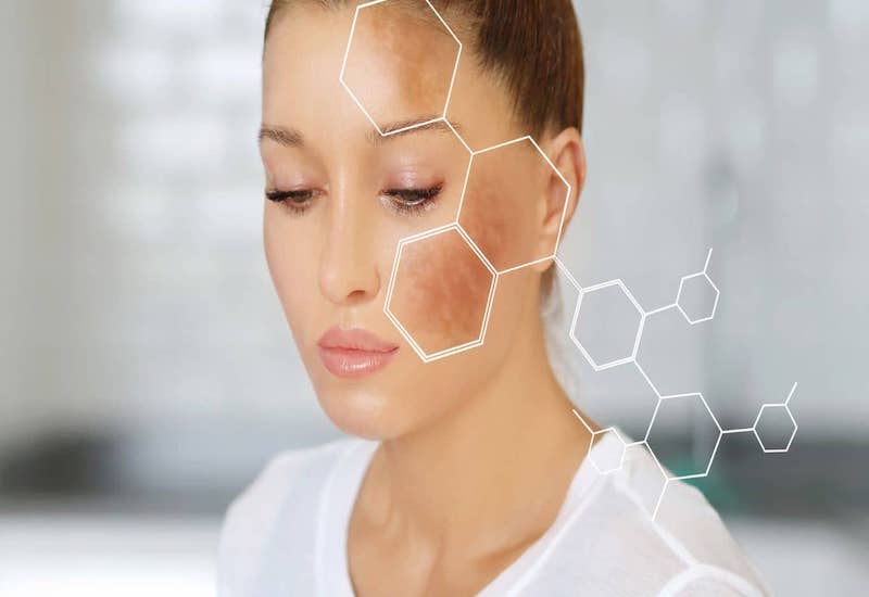 Metapeel: Công nghệ laser ít nhiệt cho da nám tái phát